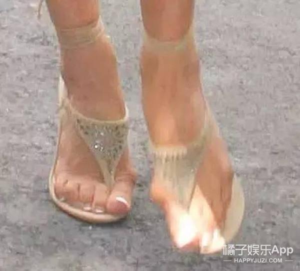 女明星的脚趾头最美_贝嫂拇指外翻手术_容祖儿拇指外翻